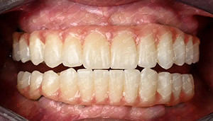 최신 회사 사례 고객 사례 4차원 지르코니아 블록