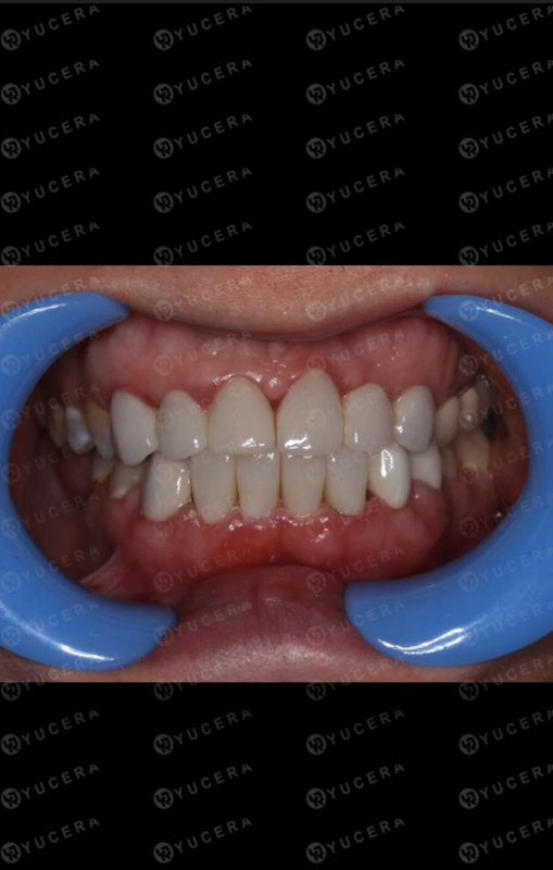 Yucera ST 컬러 치과용 지르코니아 블록, 자연스러운 치과 수복을 위한 당신의 믿음직한 선택